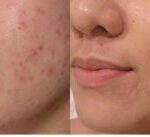 acne behandeling turnhout