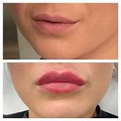 lip volume turnhout